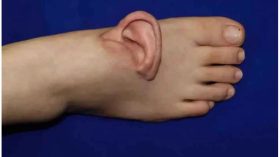 প্রথমবারের মতো বিচ্ছিন্ন কান পায়ে প্রতিস্থাপন